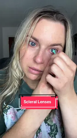 Taking out my scleral lenses   #scleralenses #sclerallenses #contacts #dryeyes #keratoconus 