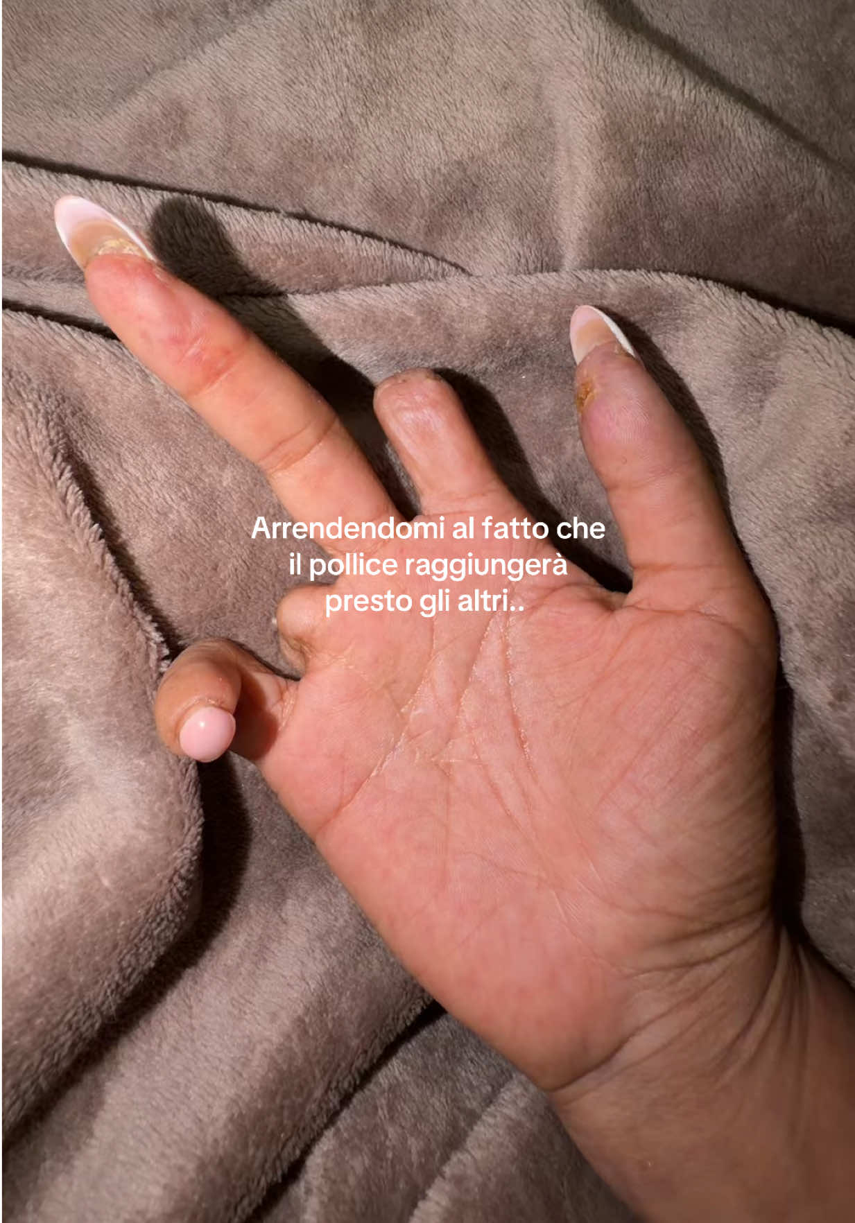 Sentimenti contrastanti.. non so se ridere o piangere 😩..  2 ulcere nello stesso dito contemporaneamente.. la sclerodermia eccelle in ciò che fa..  #LaSclerodermica #ulceredigitali #Scleroderma #sclerosistemica #fenomenodiraynaud 