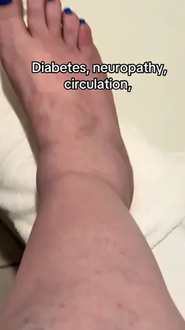 #Neuropathy #Diabetes #CompressionSocks #Swelling #SoreFeet I cannot begin to tell you how much I love these socks and I wear them every single day. They have a really come in handy and have eliminated that swelling and pain when I travel, especially 