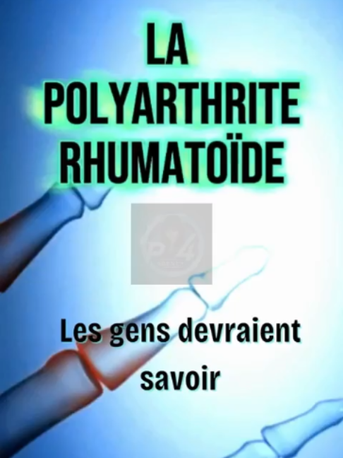 La polyarthrite rhumatoïde : quand chaque articulation peut devenir un combat… Aujourd’hui, parlons de cette maladie invisible qui fait pourtant souffrir au quotidien. #santé#DouleurChronique#PolyarthriteRhumatoide#articulation#info