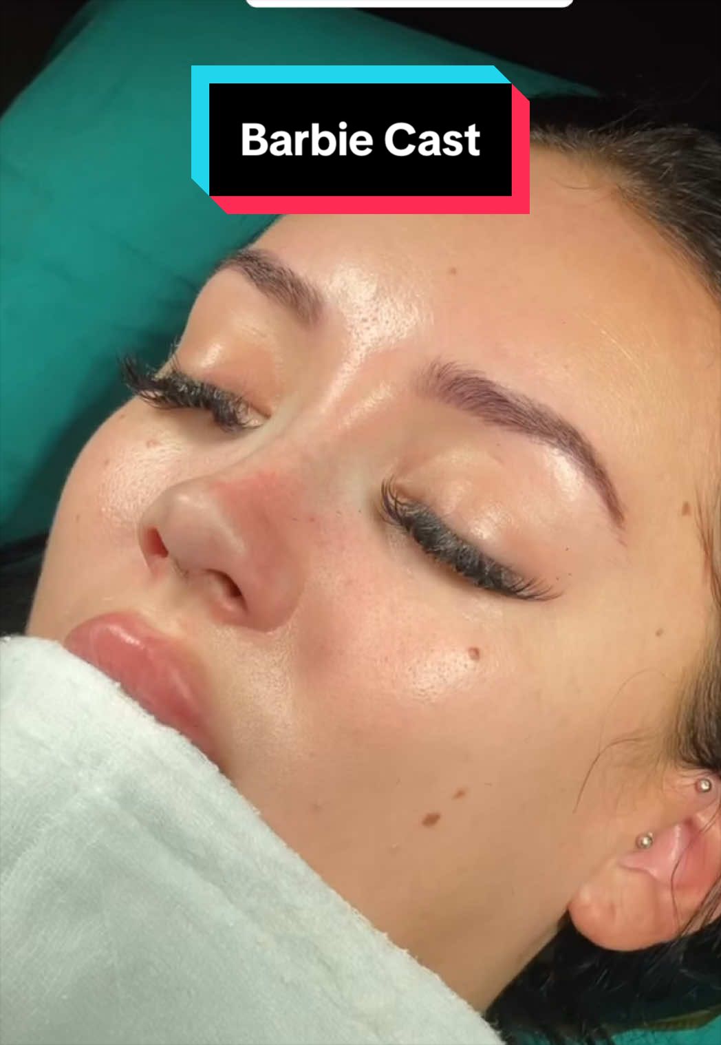 #rhinoplasty #barbienose #rhinoplastyturkey #nosejob #nosejobturkey 