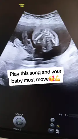 #Pregnant #PregnancyJourney #anomaly #Fyp #ultrasound 
