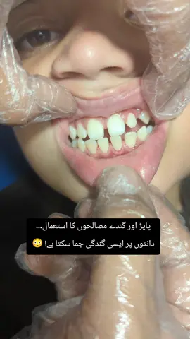 From heavy tartar buildup to a cleaner smile. #healthysmile #afterbefore #scaling #dentistry #teethpolishing 