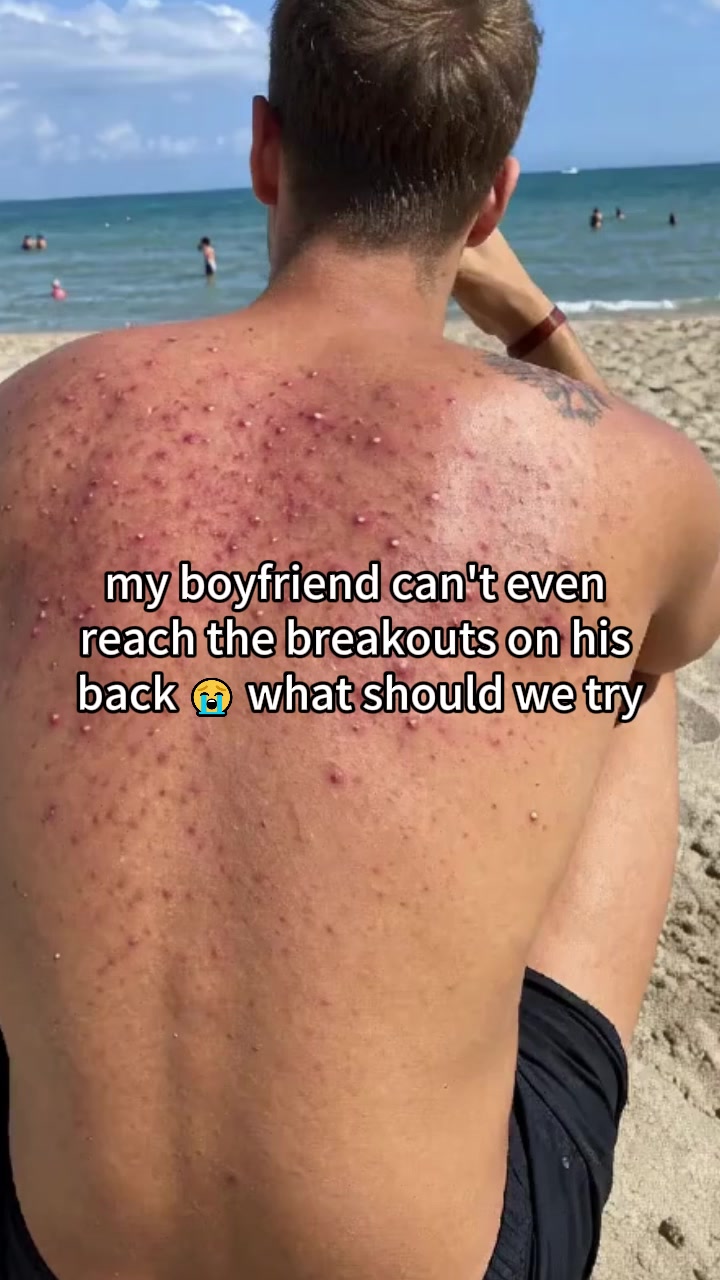 Please help me, everyone, so I can help my boyfriend. #skincaretips #bacne #adultacne #acnetreatment #fyp