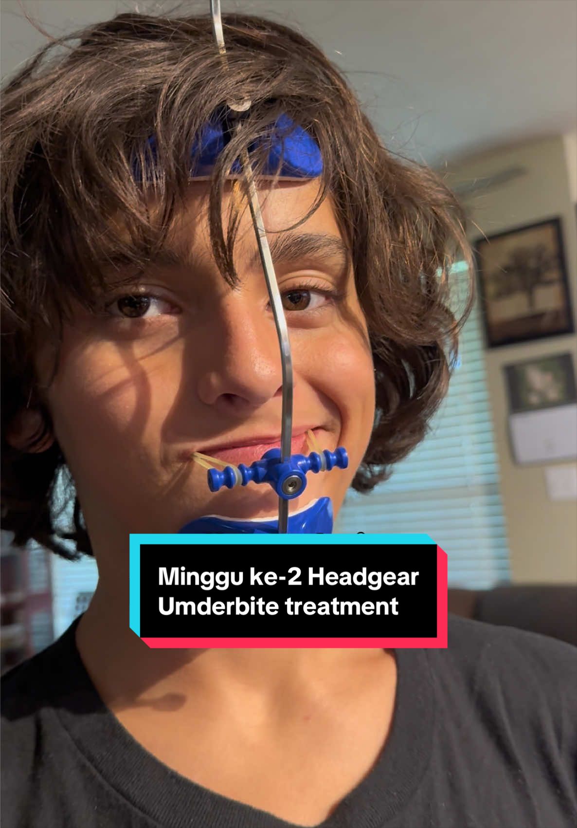 Minggu pertama headgear ternyata benar-benar masa adaptasi. Belajar tidur dengan alat ini, belajar makan, belajar melakukan aktivitas sehari-hari… semuanya terasa berbeda. Tapi setelah satu minggu, mulai ada perubahan kecil. Bukan cuma soal alatnya… tapi tentang belajar sabar menjalani proses. Ini baru minggu kedua. Perjalanannya masih panjang. Kita lihat sampai sejauh mana prosesnya nanti. ❤️ #orthodontics #underbite #treatment #dentist #cameuh🤭🤣🥰 