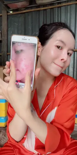 #mỡtrăn #căngbóng #mờ_nám_tàn_nhang #bầuvẫnphảixinh #mỡ_trăn_tươi 