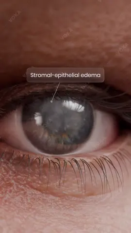 Fuchs Endothelial Corneal Dystrophy 👁️ — visualised by VOKA  This 3D medical animation demonstrates Fuchs endothelial corneal dystrophy — a progressive, inherited autosomal dominant disorder of the corneal endothelium. It is characterized by the deposition of guttae, progressive loss of endothelial cells, and the development of stromal and epithelial edema. Each VOKA project blends clinical accuracy with cinematic 3D quality, validated by medical experts. We partner with ophthalmologists, corneal surgeons, and device companies — transforming complex eye pathology into crystal-clear visuals. Whether you need mechanism of disease animation, surgical technique demonstration, device visualization, anatomy training, or patient education content we tailor every frame to your needs. 📌 Need custom 3D medical animations tailored to your project? Contact us to bring your ideas to life! 🔗 Links in bio. #Fuchsendothelialdystrophy #3danimation #3Danatomy #meded #medtech