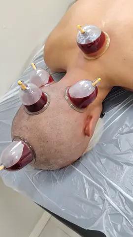 الحجامة العلاجية والوقائية بالمدينة المنورة.  خبرة 10 سنوات . يوجد حجامة رجالية ونسائية يوجد زيارت منزلية يوجد حجامة نارية وهوائية يوجد حجامة علاجية وتنشيطية ووقائية  للتواصل : 055673739
