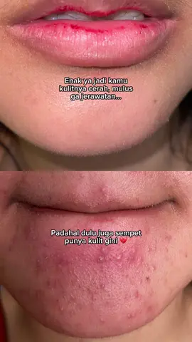 Kuncinya cuman 1 fokus ke 1 produk ini aja juga udah cukup banget loh Babes 💁🏻‍♀️ Cbain deh Melted Moist Barrier Water Cream 🤍 #Skincare #Moisturizer #Skindyssa 