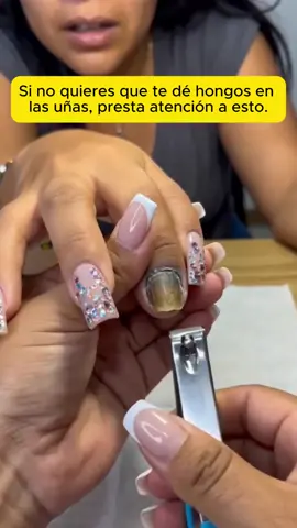 Ashamed to wear sandals because of this? 🩴 We’ve been there. This changes everything.#nailcare #nailtreatment #onychomycosis #glowup #tiktokmademebuyit  