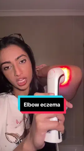 My Elbow eczema is calming down🙌🏽 Products: - Red light therapy device from www.amareskin.com (or click link in my bio) - Pure Cream from DisChem - I forgot where I got my elbow bandages🙈 but you can use any bandages or cotton clothing