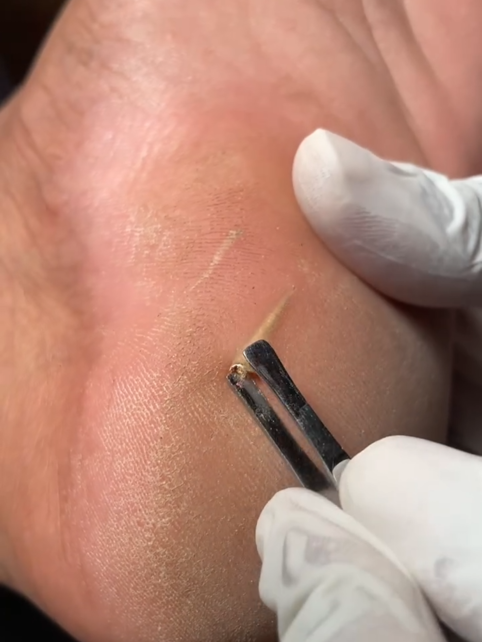 I Was Holding My Breath Until That Came Out 😮‍💨 #Satisfying #Relief #SplinterRemoval #OddlySatisfying #ViralReels