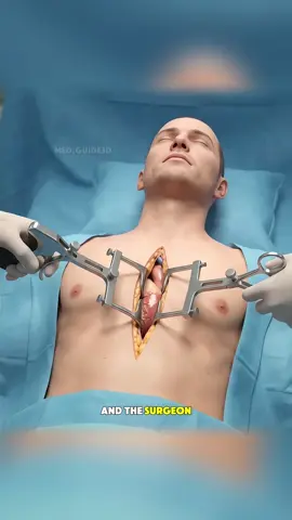 Heart Bypass Surgery (3D Animation) #HeartBypass #CABG #CardiacSurgery #HeartSurgery #CoronaryArteryDisease     