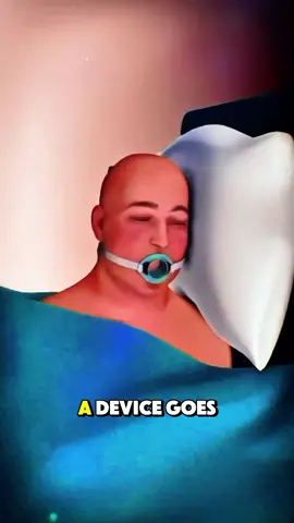 How Incisionless Fundoplication Surgery Is Done #IncisionlessFundoplication #TIFProcedure #GERD #AcidReflux #EndoscopicSurgery 