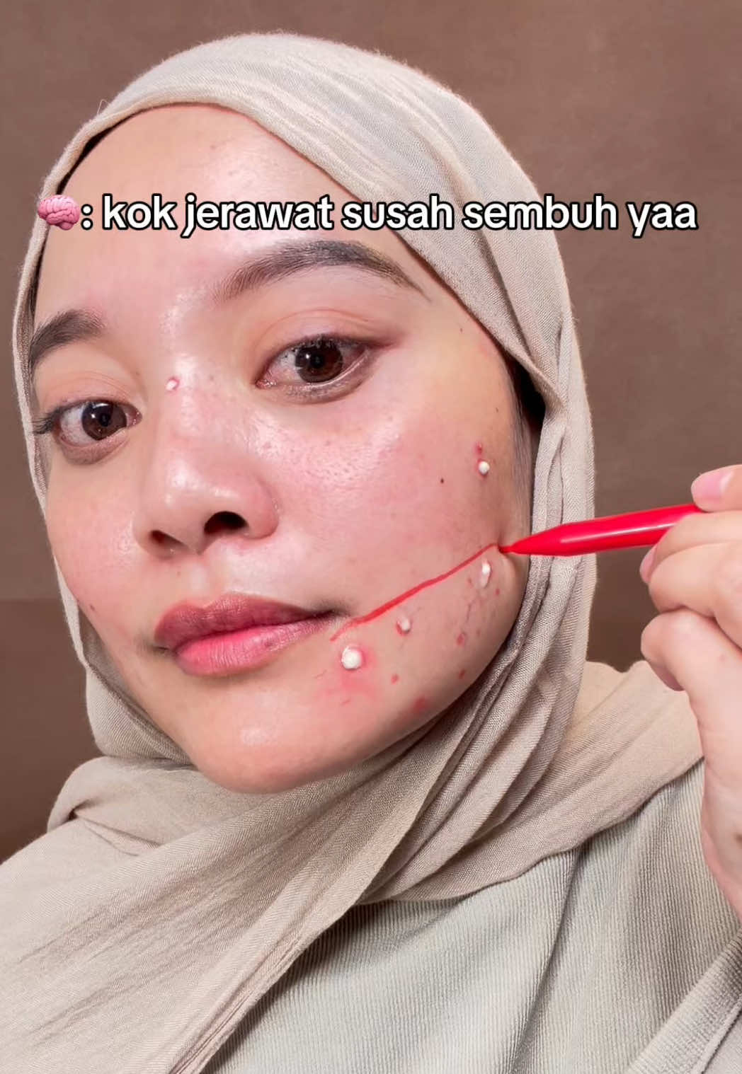 Sengaruhh itu buat jerawat 🥺💕 #acnetreatment #acnaway#acnefighter #obattotoljerawat #fyp 