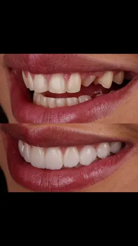 Lentes em canino incluso  O que acharam? #lentesdecontacto  #smile  #venners  #institutorildolasmar  #dentistry 