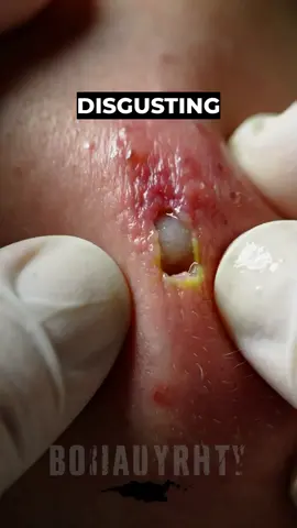 Is it more satisfying to watch or totally stomach-churning? #CystBurst #ASMRContent #SatisfyingGross #RealASMR #CheesyPus #NoBlood #RawContent #ExtremeCloseUp #MatteSkin