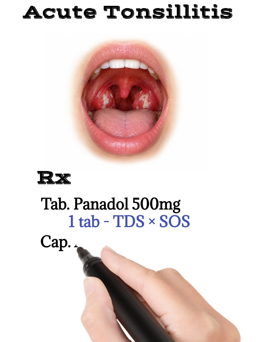 Acute Tonsillitis Treatment  #tonsillitis #pharyngitis #ent #medicaleducation #medicine 