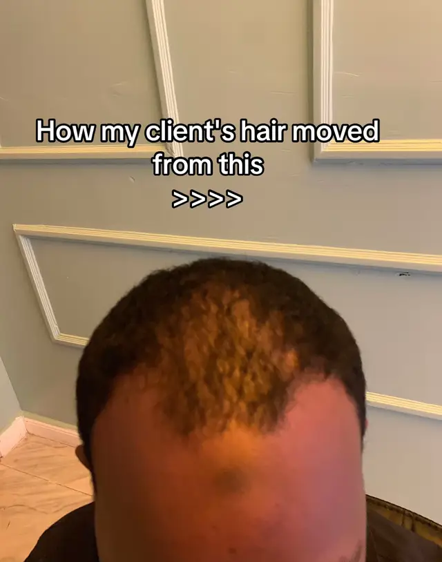 Your daily hair-growth routine: Minoxidil + Derma Rolling + pumpkin seed oil & Saw Palmetto 🌱💪 Consistency is key! #hairgrowth #consistency #viralfyp 