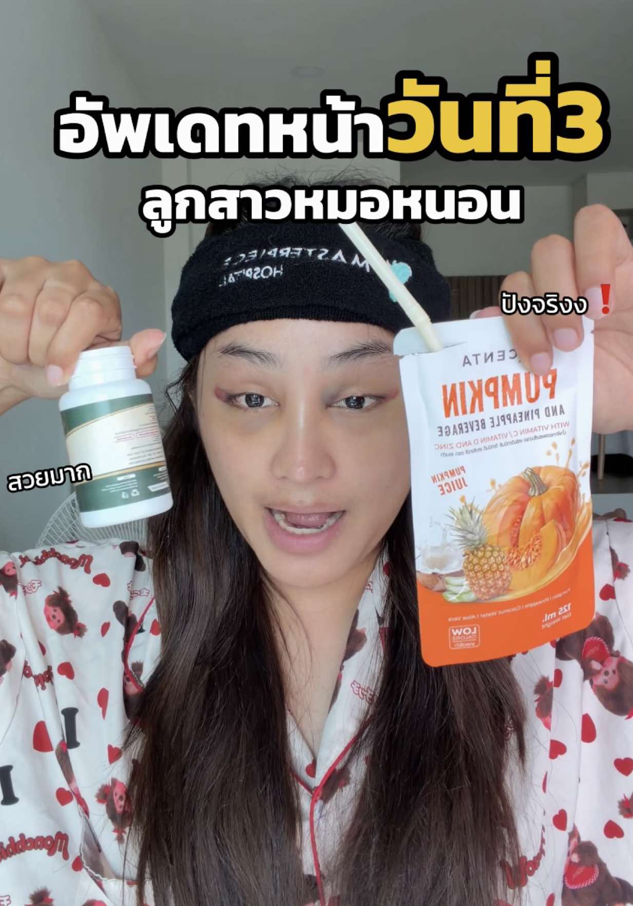 วันที่3 แล้วแม่ ใกล้หายแล้วเว้ย🤭💕#บีก้าปลาเก๋า #เสริมหน้าผากมาสเตอร์พีซ #เสริมหน้าผาก #MasterpieceHospital #หมอหนอนมาสเตอร์พีช 