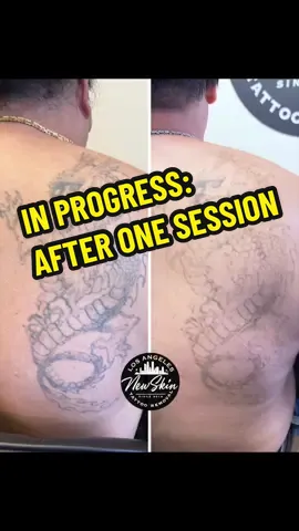 My client at our LA location has only had ✨ONE session✨ with me on this old back tattoo. He spaced his session out 4 months. His 2nd session was last weekend! Follow me for updates on his progress!⚡️☺️ If you’re interested in starting your affordable laser tattoo removal journey with us, send a text to any of the numbers in my bio! #lasertattooremoval #fyp #tattoos #losangelestattooremoval #lasertattooremovalspecialist 