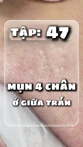 Lime chuyên mụn Bình Thạnh #nanmunbangtay #spabinhthanh #munan #dieutrimun #limechuyenmun 