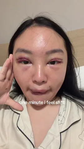 1 month double eyelid + ptosis correction + lip filler @Woori Plastic Surgery @IndoUnni 