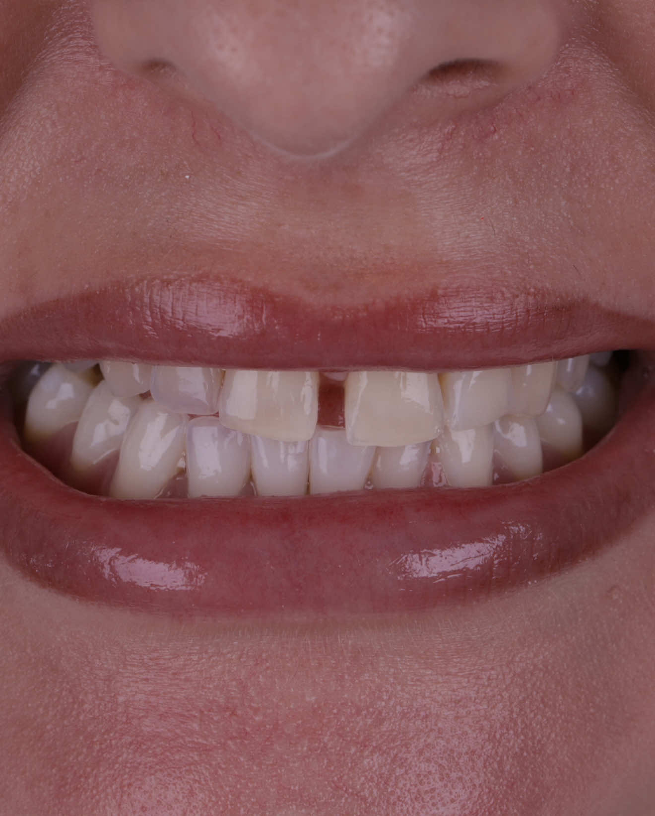 Fechamento de diastema, construindo um sorriso harmônico e natural 🤌🏼✨🖌️ . . Um pouquinho do processo de como eu faço as minhas lentes em resina ❤️#resin #resinart #dentist #dentistry #composite 