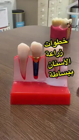 كيف منزرع سن ؟ #creatorsearchinsights #fyp #dental #learnontiktok  @dr.somar | د.سومر 