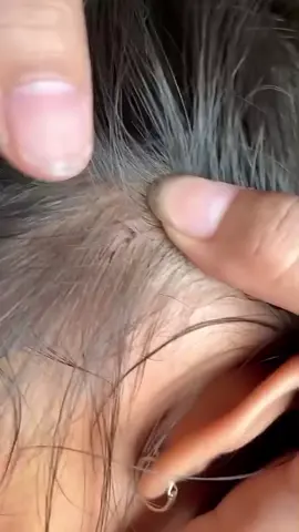 lice removal #tiktokgrowthchallenge #lice #viral #trending #fyp 