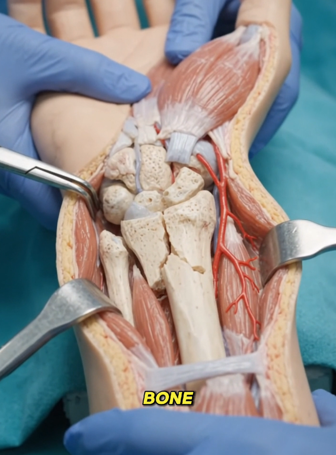 How Surgeons Fix a Broken Wrist#healthcoach #surgery #medicalanimation #healtheducation #tiktokdoctor 