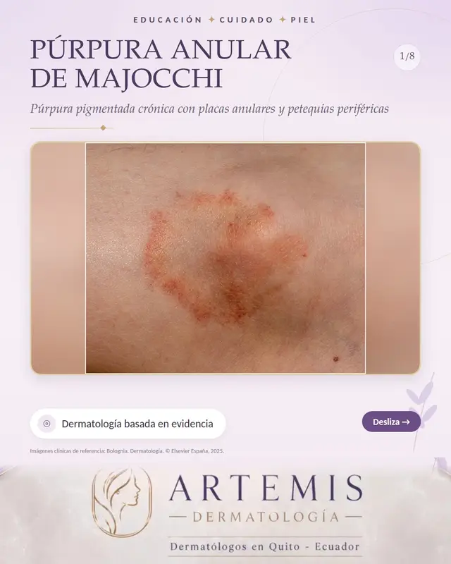 La púrpura anular telangiectoide de Majocchi es una de las variantes de las dermatosis purpúricas pigmentadas crónicas, también llamadas capilaritis, un grupo de trastornos benignos caracterizados por la inflamación de los capilares de la dermis superficial con extravasación de hematíes y depósito de hemosiderina. Afecta con más frecuencia a adolescentes y adultos jóvenes, con predominio femenino. Clínicamente se presenta con placas anulares de crecimiento centrífugo lento, de color rojo a marrón, con petequias y telangiectasias puntiformes en el borde, como granos de pimienta de cayena, y un centro que se aclara o se vuelve ligeramente atrófico. Se localiza sobre todo en las piernas, de forma bilateral y a menudo simétrica, aunque puede extenderse a los muslos, los glúteos y los brazos. Suele ser asintomática. Algunos casos se relacionan con fármacos, insuficiencia venosa o ejercicio. La dermatoscopia muestra puntos y glóbulos rojos sobre un fondo cobrizo. La biopsia muestra infiltrado linfocitario perivascular superficial, hematíes extravasados y hemosiderina, sin vasculitis. Las pruebas de coagulación y el recuento de plaquetas son normales. El tratamiento incluye corticoides tópicos, rutósido con vitamina C, compresión y fototerapia en casos extensos. Dr. Javier Rosero · Dermatólogo · Quito – Ecuador · Contacto: 0982453672 Imágenes clínicas de referencia: Bolognia. Dermatología. © Elsevier España, 2025. Material docente, no son casos propios. #purpura #piernas #dermatologia #dermatologoquito #quito #medicina