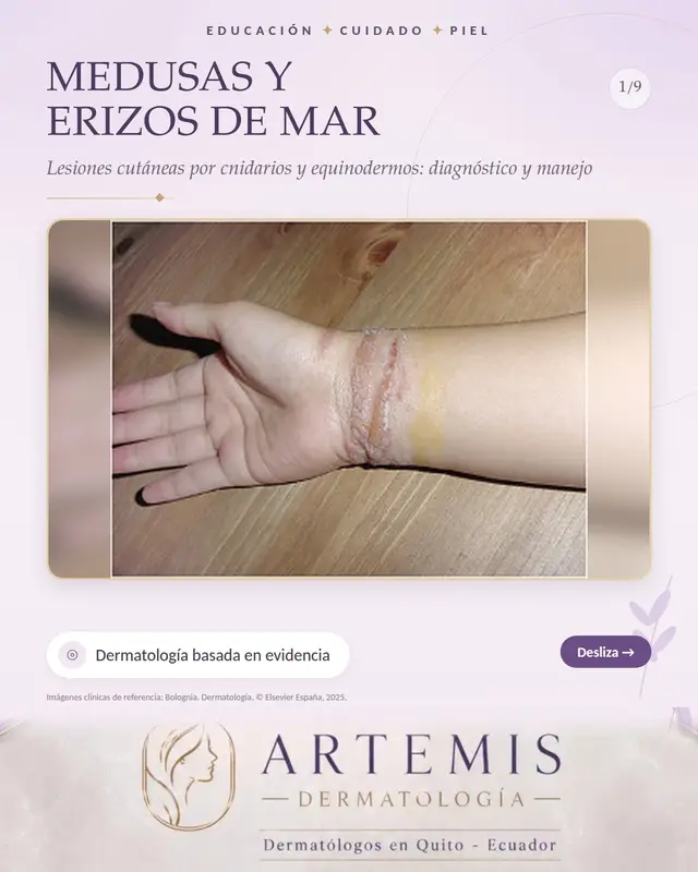 Las lesiones por animales marinos son frecuentes en zonas costeras y durante las vacaciones de playa. Las medusas y otros cnidarios, como la carabela portuguesa, poseen en sus tentáculos células llamadas cnidocitos con nematocistos, cápsulas que al contacto disparan un filamento que inyecta toxinas en la piel. La picadura produce dolor quemante inmediato y lesiones eritematosas, edematosas o urticariales, con frecuencia lineales o en látigo que reproducen la forma del tentáculo, que pueden evolucionar a vesículas, ampollas, necrosis e hiperpigmentación residual; en especies peligrosas pueden aparecer síntomas generales como náuseas, calambres, dificultad respiratoria o colapso. El erizo de mar produce lesiones al pisarlo: las espinas de carbonato cálcico se clavan, sobre todo en la planta del pie, dejando puntos negros o violáceos dolorosos, y los fragmentos retenidos pueden causar granulomas a cuerpo extraño semanas después. En la picadura de medusa se recomienda salir del agua, lavar con agua de mar sin frotar, retirar los restos de tentáculos con pinzas, aplicar calor o frío según la especie, y usar analgésicos y corticoides tópicos; el vinagre es útil en algunas especies. En las lesiones por erizo se sumerge la zona en agua caliente y se extraen las espinas accesibles. Dr. Javier Rosero · Dermatólogo · Quito – Ecuador · Contacto: 0982453672 Imágenes clínicas de referencia: Bolognia. Dermatología. © Elsevier España, 2025. Material docente, no son casos propios. #playa #picaduras #dermatologia #dermatologoquito #quito #medicina