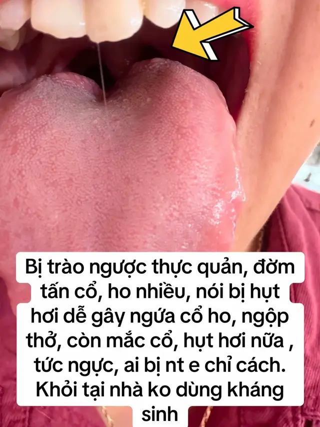 Bị trào ngược thực quản, đờm tấn cổ, ho nhiều, nói bị hụt hơi dễ gây ngứa cổ ho, ngộp thở, còn mắc cổ, hụt hơi nữa , tức ngực, ai bị nt e chỉ cách. Khỏi tại nhà ko dùng kháng sinh