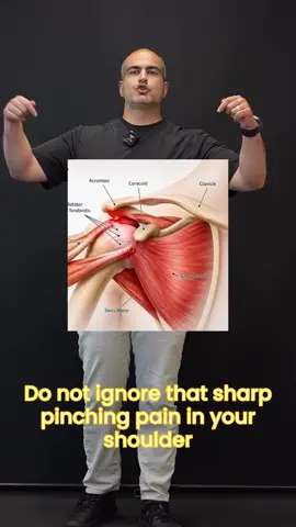 Sharp Pain When Lifting Your Arm Overhead? It Could Be Shoulder Impingement. Shoulder impingement describes pain that occurs when structures around the rotator cuff and subacromial space become irritated, often during repetitive or overhead movements. Common signs: ✅ Pain lifting your arm overhead ✅ Pain through the middle range of lifting your arm ✅ Pain reaching behind your back ✅ Weakness or discomfort with lifting ✅ Pain when lying on the affected shoulder 💪 Try the exercises in this video: Perform 3 sets of 10–15 reps, moving slowly and with control. Improving rotator cuff strength, shoulder blade control, and shoulder mobility can help reduce symptoms and get you back to lifting, training, and everyday activities. #shoulderimpingement #shoulderpain #rotatorcuff #shoulderrehab #shoulderstrength