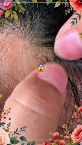 #omg #liceremoval #brazil #fyp #trending 