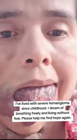 I’ve lived with severe hemangioma since childhood. I dream of breathing freely and living without fear. Please help me find hope again.