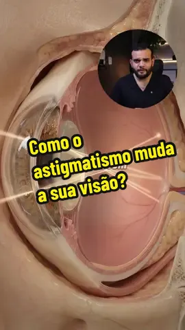 Você vê faróis com riscos de luz à noite? Isso pode acontecer por causa do astigmatismo. Nesse caso, a luz não é focalizada perfeitamente em um único ponto da retina, o que pode deixar a visão borrada, distorcida e aumentar os halos ao redor das luzes. Por isso muita gente percebe o problema principalmente dirigindo à noite. Você também enxerga as luzes desse jeito? #astigmatismo #visao #olhos #oftalmologia #medicina 