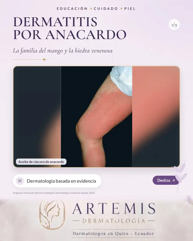 La dermatitis por anacardo es una dermatitis de contacto alérgica causada por el aceite que contiene la cáscara del anacardo o marañón, rico en sustancias como el ácido anacárdico y el cardol, muy similares al urushiol de la hiedra venenosa. El anacardo pertenece a la familia de plantas Anacardiaceae, que incluye también el mango, el pistacho y la hiedra y el roble venenosos, por lo que una persona sensibilizada a una de ellas puede reaccionar a las demás. Se observa sobre todo en trabajadores que procesan anacardos, en contacto con la cáscara, y en personas que manipulan la piel del mango, que puede producir dermatitis alrededor de la boca. Los anacardos que se venden para consumir ya están procesados y no suelen contener este aceite. Uno o dos días después del contacto aparecen enrojecimiento, pápulas, vesículas y ampollas muy pruriginosas, a menudo en disposición lineal donde la planta rozó la piel, con edema llamativo en párpados y cara. El diagnóstico se basa en la historia de exposición y en el aspecto clínico, y las pruebas epicutáneas pueden ayudar en casos dudosos; debe diferenciarse de la dermatitis irritativa y de otras dermatitis. El tratamiento consiste en evitar el contacto, lavar la piel y la ropa expuestas, aplicar corticoides tópicos potentes y, en casos extensos o con afectación facial importante, administrar corticoides orales durante varias semanas. En el trabajo se recomienda el uso de guantes adecuados. Dr. Javier Rosero · Dermatólogo · Quito – Ecuador · Contacto: +593 98 24 53 672 Imágenes clínicas de referencia: Bolognia. Dermatología. © Elsevier España, 2025. Material docente, no son casos propios. #dermatitisdecontacto #plantas #dermatologia #dermatologoquito #quito #medicina