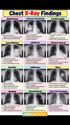 Chest X-ray findings#@RRT.kvillz5 #plzunfreezmyaccount🙏🙏🙏🙏 #viralvideos 