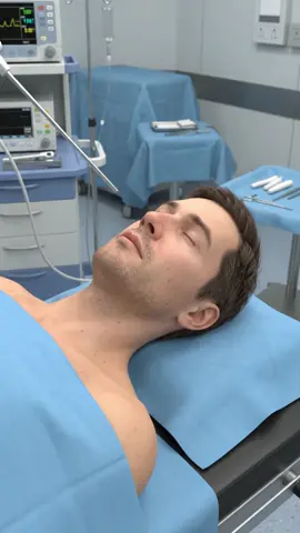O que é a Cirurgia Sinusal Endoscópica (FESS)?** 👃 A Cirurgia Sinusal Endoscópica Funcional (FESS) é uma procedura mínimamente invasiva usada para melhorar os caminhos de drenagem e ventilação naturais dos sinusos. Um endoscópio fino é passado pelo nariz, permitindo ao cirurgião examinar os canais nasais e tratar cuidadosamente os caminhos bloqueados ou estreitados dos sinusos. **Por que a FESS é realizada?** A FESS pode ser recomendada para pessoas com problemas crônicos nos sinusos, quando o tratamento médico adequado não for suficientemente efetivo. Pode ajudar a tratar condições como sinusite crônica, polpôs nasais e caminhos de drenagem dos sinusos bloqueados. Nesta animação, mostramos a sequência geral da FESS — desde a inserção do endoscópio e a identificação do bloqueio até a abertura do caminho de drenagem e a remoção de uma obstrução, quando necessário.#reelvideos #anatomia #curiosidades @Velhosabiooficial @Velhosabiooficial #LIVEIncentiveProgram #LIVEwithlowfollowers 