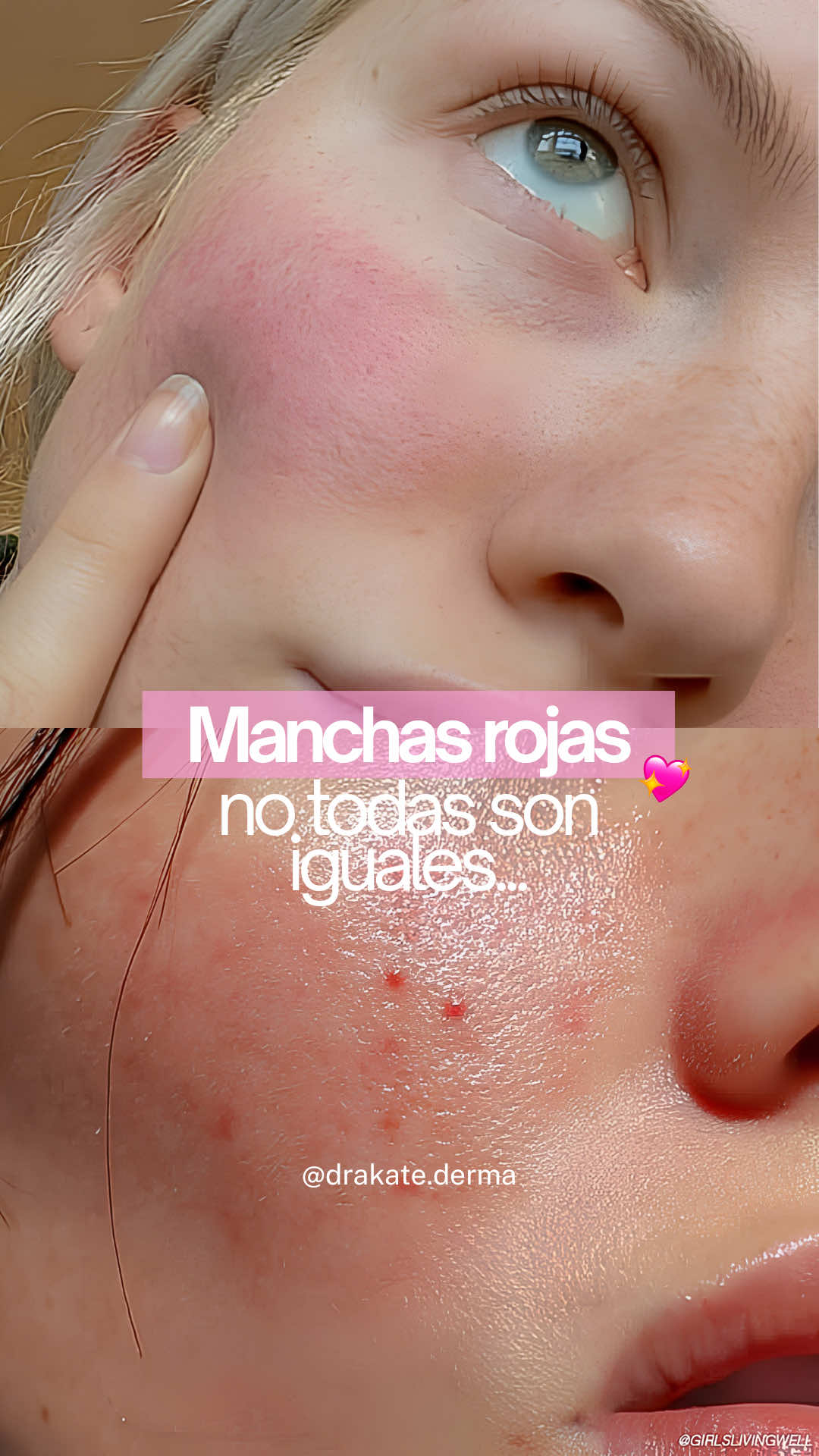 ¿Manchas rojas en el rostro? Ojo, no todas significan lo mismo. 🔎
 
 Rosácea, dermatitis seborreica, lupus cutáneo, dermatomiositis, tiña facial y lupus pernio pueden verse similares, pero sus causas y tratamientos son muy diferentes. 👩🏻‍⚕️
 
 Por eso, no te automediques ni pruebes cremas al azar. Primero hay que identificar qué está pasando con tu piel.
 
 ¿Tienes una lesión parecida? Cuéntame en los comentarios. 👇🏻
 
 📲 Si quieres una evaluación, agenda tu cita: 51 932 393 587
 📍 Miraflores, Lima - Perú.
 
 #rosacea #dermatitisseborreica #lupuscutaneo #dermatomiositis #tiñafacial  