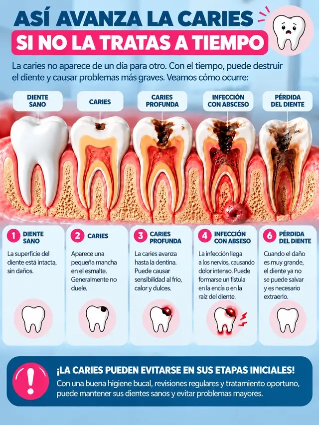 Sé sincero… ¿cuál es tu mayor preocupación dental? 👀🦷 ¿Manchas en los dientes? ¿Sensibilidad dental? ¿Placa bacteriana? ¿Mal aliento? ¿Caries? Si no se tratan a tiempo, estos problemas pueden empeorar progresivamente. Algunos pueden provocar inflamación del nervio dental, complicaciones e incluso la pérdida de dientes. 🦷⚠️ #SaludDental #CuidadoDental #SaludBucal #DientesSanos #DatosDentales