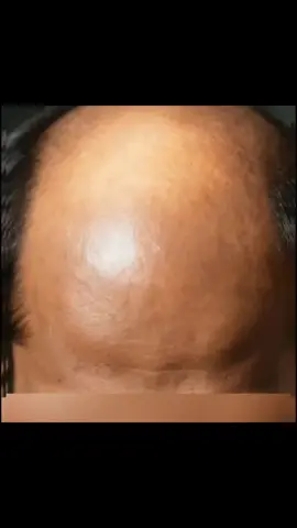 Hairline Reset: Scalp First, Stop Guessing—Fix Your Routine  tictokgermany🇩🇪🇦🇫🇮🇳  #germany🇩🇪_tik_tok🍀🌹  #germany🇩🇪  #🇧🇪🇫🇷🇳🇱🇪🇸🇩🇪🇮🇹🇨🇭🇲🇦🇵🇹🇹🇳🇹🇷🇩🇿  #🇧🇪_المانيا🇩🇪_اسبانيا🇪🇸 Your wash routine could be sabotaging you.