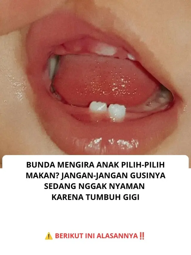 Bunda, si kecil yang biasanya lahap tiba-tiba menolak makanan? Salah satu kemungkinan yang perlu diperhatikan adalah rasa tidak nyaman pada gusi saat gigi tumbuh. Kondisi ini bisa membuat anak lebih rewel atau sementara waktu kurang tertarik makan. 🔎 Kenapa tumbuh gigi bisa memengaruhi waktu makan? 🦷 1. Gusi terasa nyeri atau sensitif Saat gigi mulai muncul, gusi bisa terasa tidak nyaman, terutama ketika terkena makanan. 🍽️ 2. Tekstur makanan terasa kurang nyaman Anak mungkin lebih menerima makanan bertekstur lembut untuk sementara waktu. 😣 3. Anak menjadi lebih rewel Rasa tidak nyaman bisa membuat si kecil lebih mudah menangis atau menolak suapan. 💧 4. Air liur lebih banyak Produksi air liur dapat meningkat ketika gigi tumbuh, meskipun tanda ini tidak selalu berarti anak sedang tumbuh gigi. 💡 Apa yang bisa Bunda lakukan? - Tawarkan makanan sesuai usia dengan tekstur yang nyaman. - Berikan teether yang didinginkan di kulkas, bukan dibekukan. - Jangan memaksa atau memarahi anak saat menolak makan. - Tetap pantau asupan cairan dan pertumbuhan si kecil. ⚠️ Penting, Bun! Jangan langsung menganggap semua perilaku pilih-pilih makanan disebabkan oleh tumbuh gigi. Jika anak terus menolak makan, sulit minum, tampak lemas, atau mengalami demam tinggi, segera periksakan ke tenaga kesehatan. 💬 Bunda, si kecil pernah mendadak pilih-pilih makanan saat tumbuh gigi? Waktu itu makanan apa yang masih mau dia makan? Cerita di kolom komentar, yuk! 👇 Sumber: - NHS – Gejala Tumbuh Gigi pada Bayi - American Academy of Pediatrics – Cara Meredakan Nyeri Tumbuh Gigi #masukberanda #explore #foryou #viral #fyppppppppppppppppppppppp 