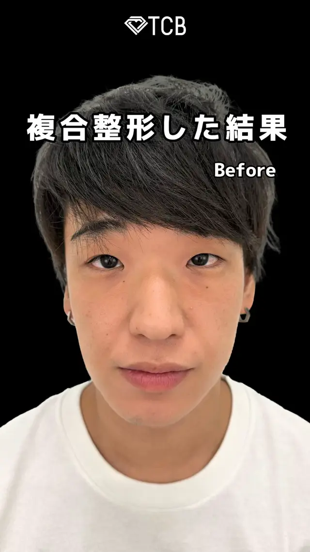 大切なことが書いてあります💁🏻‍♂️詳しい内容は【続きを読む】をタップ👇 ＼小顔整形の症例を紹介！／ 💡カウンセリングは無料です👨🏻‍⚕️ 「理想に近づけるためには何の施術をしたらいいのか知りたい！」 等カウンセリングのみも承っておりますので、お気軽にご相談くださいませ！ －－－－－－－－ 【TCB小顔リフト】 ■施術内容 頬やフェイスラインのたるみ、ほうれい線やマリオネットラインといったシワを、皮下 組織に糸を挿 入しリフトアップすることで改善する小顔治療です。 糸には、「コグ」 と呼ばれるアンカーがついていて、皮下組織にひっかけることで顔 のリフトアップ を 行います。糸が挿入されたことの刺激によって、コラーゲンが増生 され、肌のハリツヤ をアップ させる美肌効果にも期待ができます。 ■価格 本数により料金が異なります。 13,800円~239,800(税込) ■想定されるリスク ☑腫れ・内出血・ダウンタイム ほとんどありません。施術直後から数日間は軽い痛みを伴う、患部の腫れ・むくみが発 生する場合がありますが、1週間ほどでほぼ解消します。 ☑洗顔・シャワー・入浴 当日から可能 ※当日は患部を避けてください ☑メイク 術後すぐに可能 ☑副作用・合併症・リスク 腫れ、凹み、知覚異常、しびれ、違和感、針穴、内出血、糸の感染、痛み、むくみ、発 赤、つっぱり 感、皮膚の上から強く触ると糸の繊維がわかる場合があります －－－－－－－－ 【ご予約方法】 ▶︎WEB: プロフィール欄のURLをタップ！ ▶︎LINE:「@205mnyup」でID検索&友達登録！ ▶︎お電話:0120-86-7000 －－－－－－－－ #糸リフト #脂肪吸引 #TCB #東京中央美容外科 #天王寺