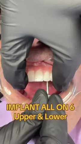 All-on-6 Implants | Upper & Lower Jaw Transformation ✨ #teeth #SmileMakeover #implantallon6 #implant 