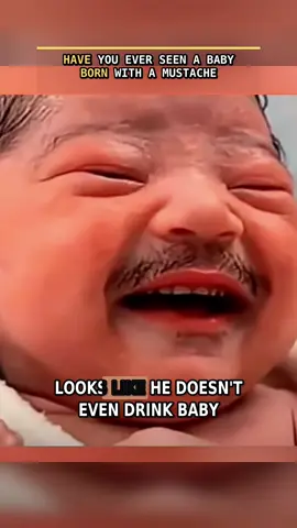 Have you ever seen a baby born with a mustache?#BabyTok #MustacheBaby #WildNews #MedicalOddities#breakingnews
