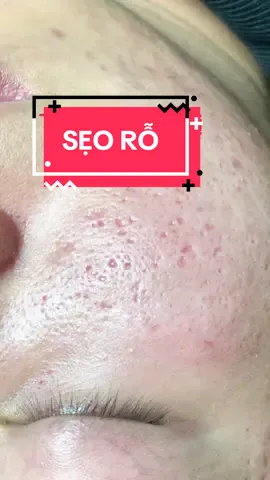 Sẹo rỗ lâu năm cải thiện quá tốt sau 4 lần điều trị, Bác sĩ Phượng nói không với dùng ap nhé, cam thường 100% #laserfractional #viraltiktok #xuhuongtiktok #bacsidalieu #sẹorỗ 