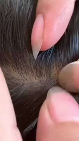 Lice Removal POV: when you realize you have more company than you thought #alice #funny #omg #brazil #grow ‎
